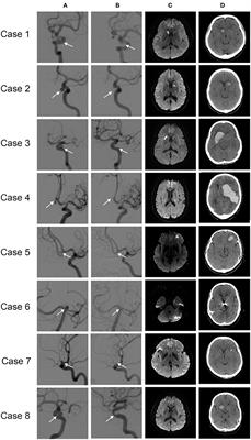 Risk Factor Analysis of Delayed Intracerebral Hemorrhage After Coil Embolization of Unruptured Cerebral Aneurysms